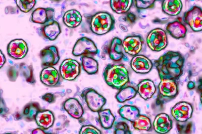 Another measles-related death reported in Pennsylvania as outbreak grows
